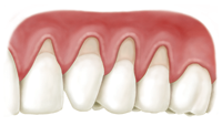 alloderm_patient_casea