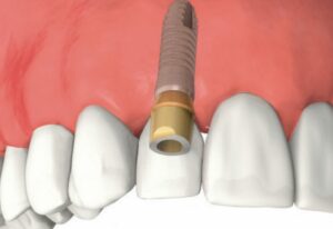 shema_implant2-1024x723