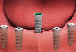 shema_implant5-300x206