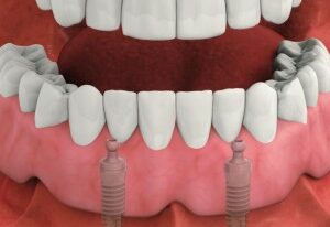 shema_implant8-300x209